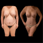 nps_before-after-abdominoplasty-tummy-tuck-1-min