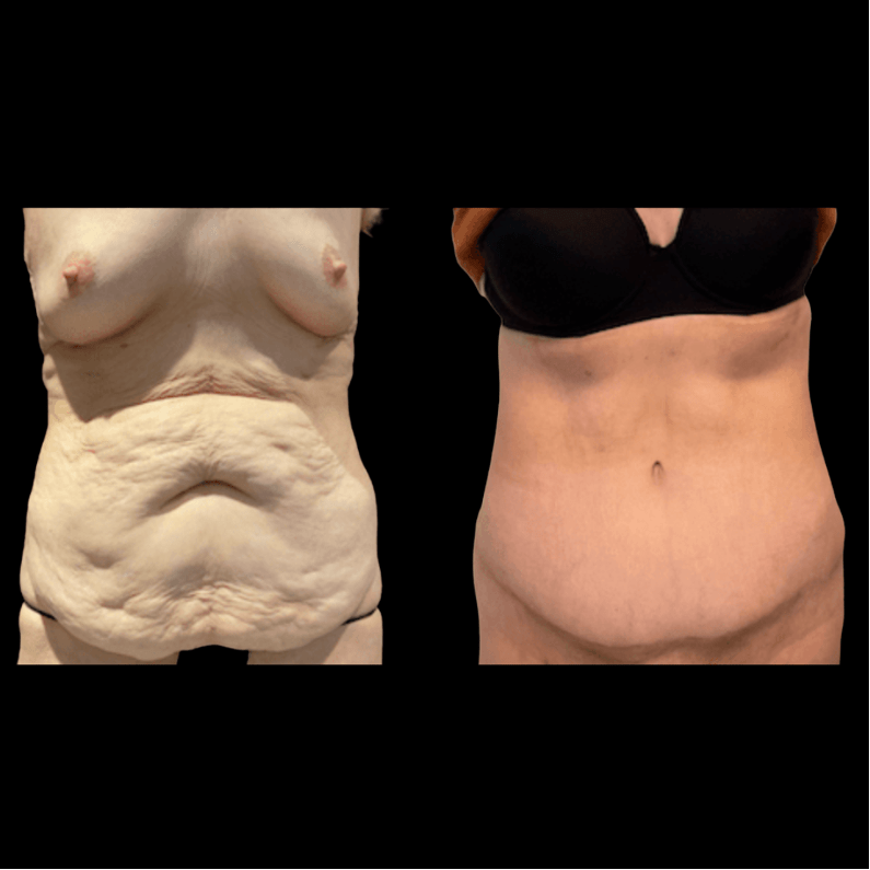 nps_before-after-abdominoplasty-tummy-tuck-1-min