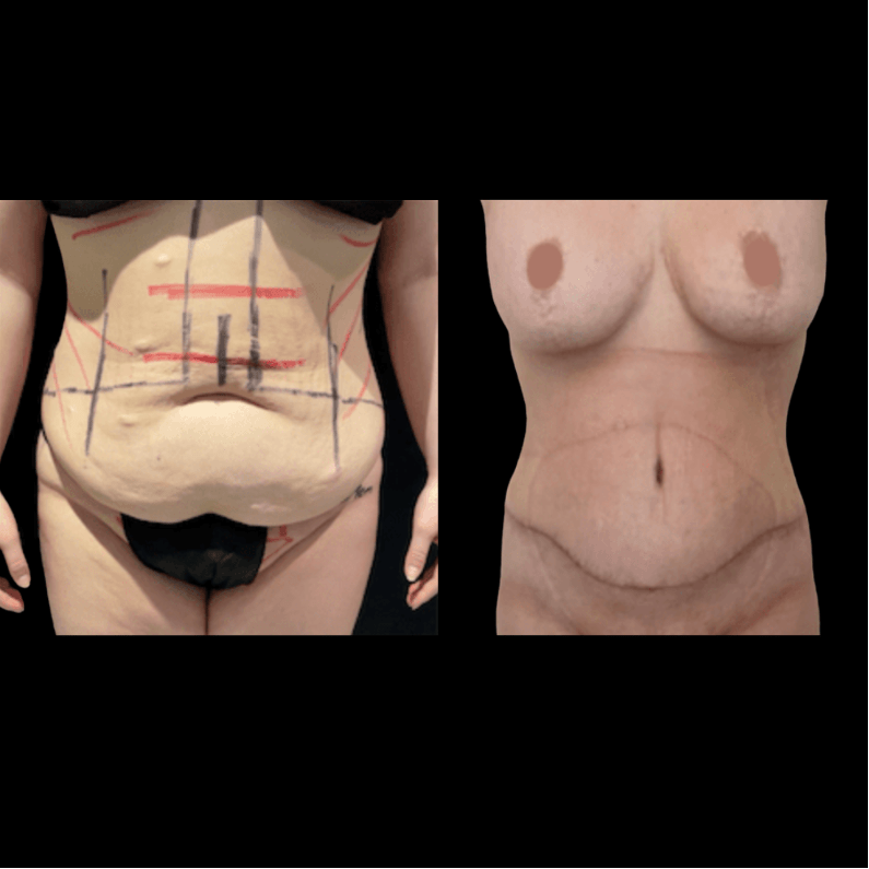 nps_before-after-abdominoplasty-tummy-tuck-1-min