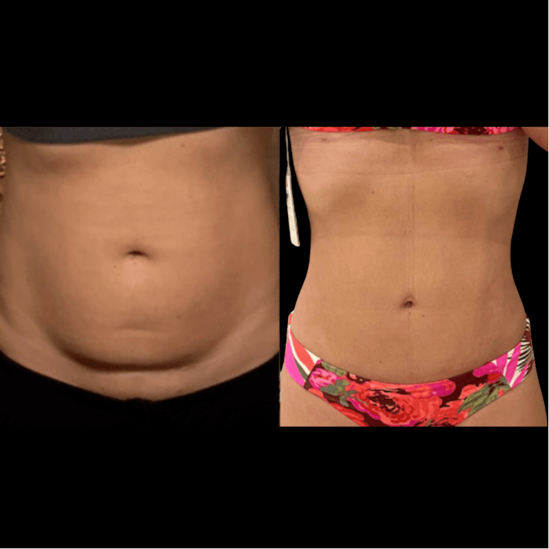 tummy tuck belly button with scar