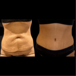 What is a reverse tummy tuck? - Dr. Hess