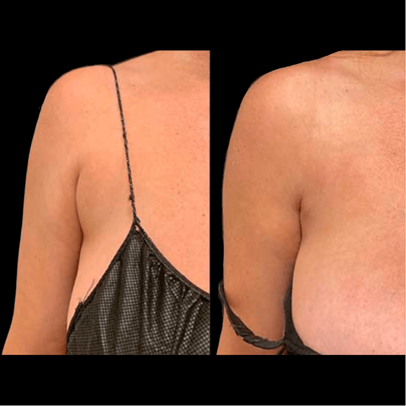 nps_before-after-arm-bra-bulge-lipo-1-min