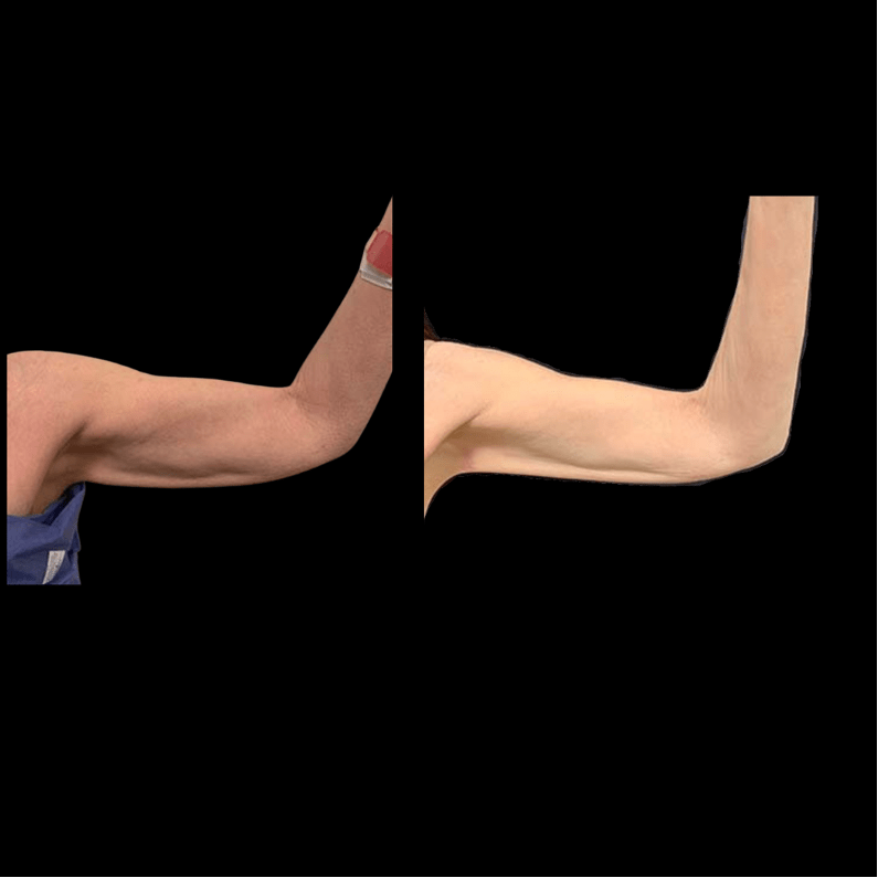 nps_before-after-arm-liposuction-1-min