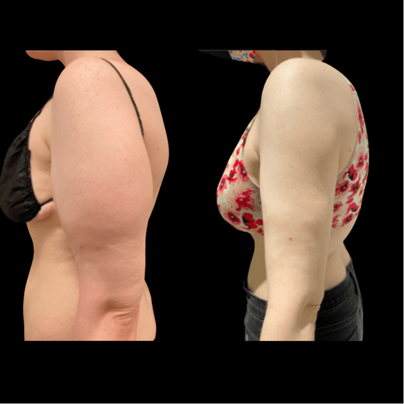 nps_before-after-arm-liposuction-1-min
