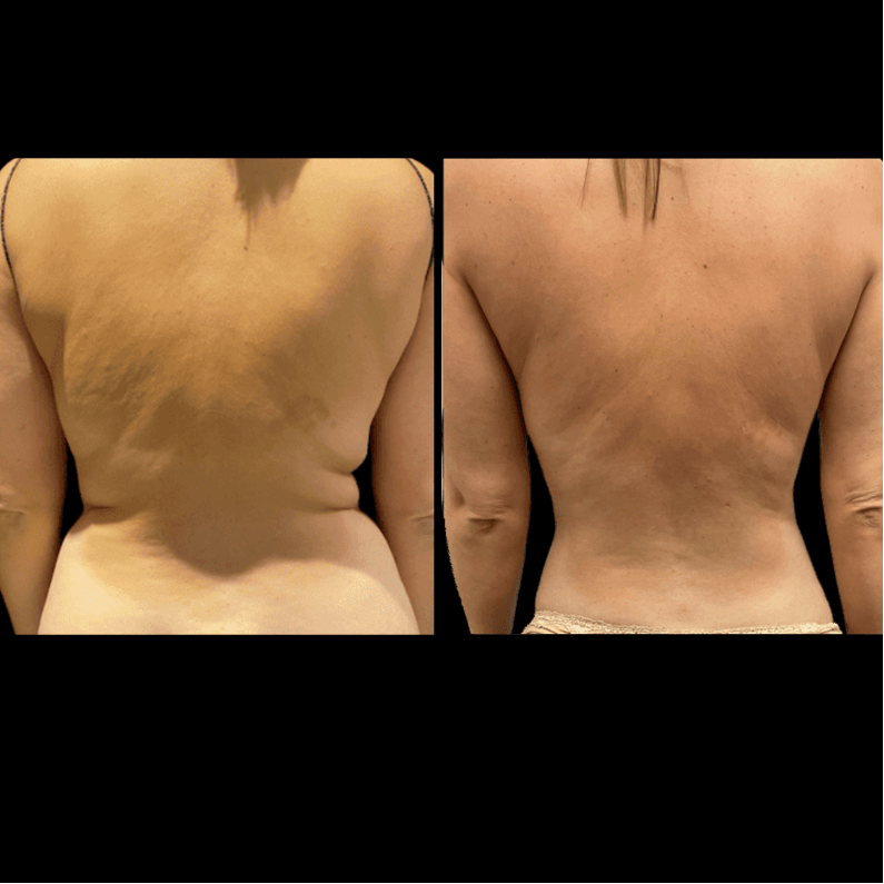 Before & After: Back Liposuction - Neinstein Plastic Surgery