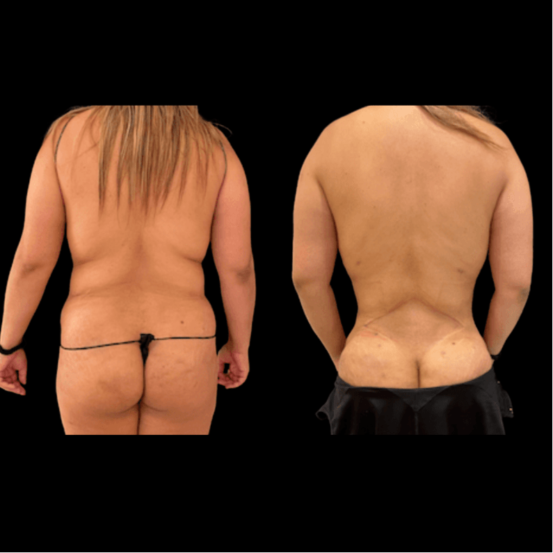 nps_before-after-back-lipo-1-min