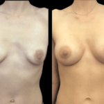 nps_before-after-breast-augmentation