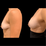 nps_before-after-breast-boost