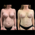 nps_before-after-breast-lift
