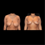 nps_before-after-breast-lift
