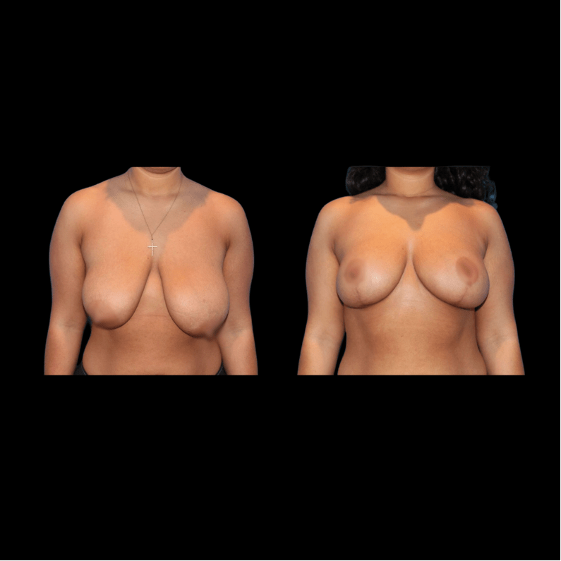 nps_before-after-breast-lift