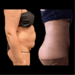 nps_before-after-coolsculpting-revision