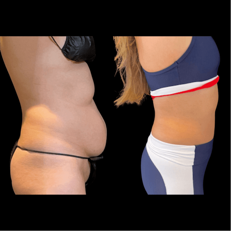 nps_before-after-coolsculpting-revision
