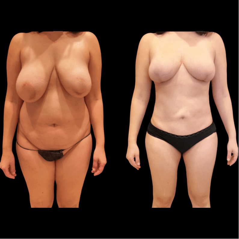 nps_before-after-lipo-360-mommy-makeover