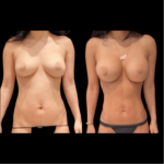 nps_before-after-lipo-360-mommy-makeover
