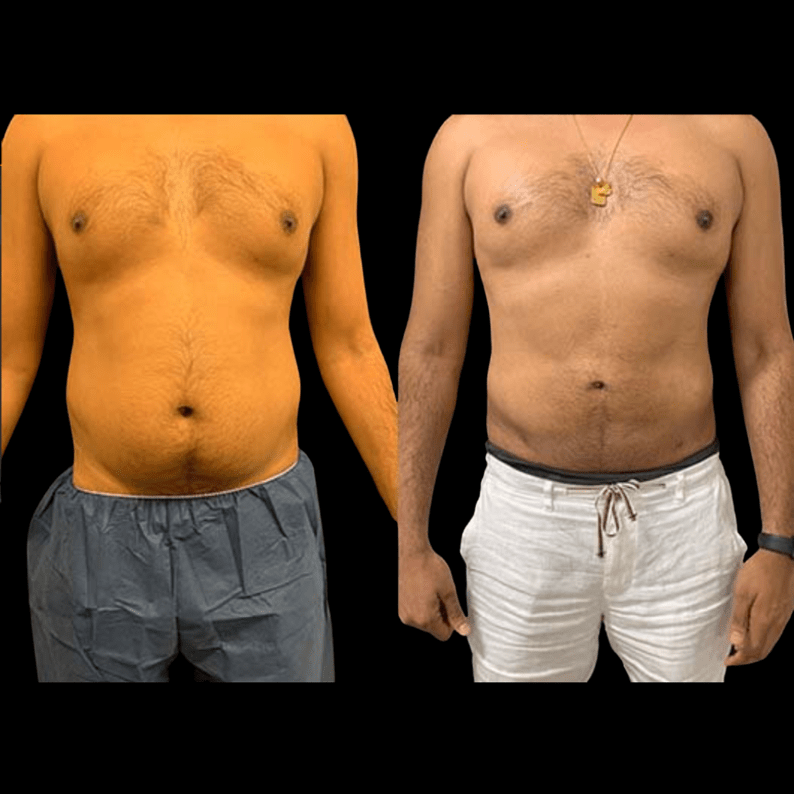 Before & After: Male Liposuction Results - Neinstein Plastic Surgery