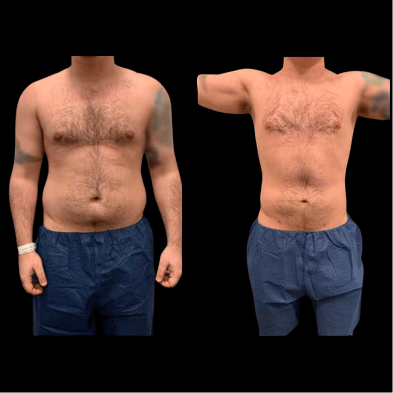 Before And After Male Liposuction Results Neinstein Plastic Surgery