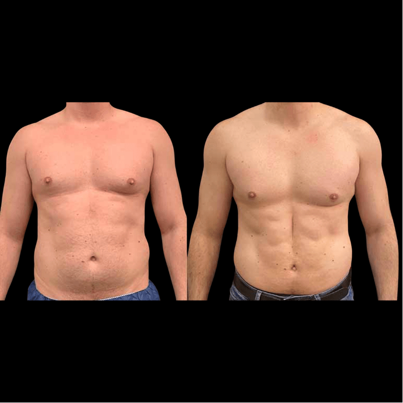 Before & After: Male Liposuction Results - Neinstein Plastic Surgery