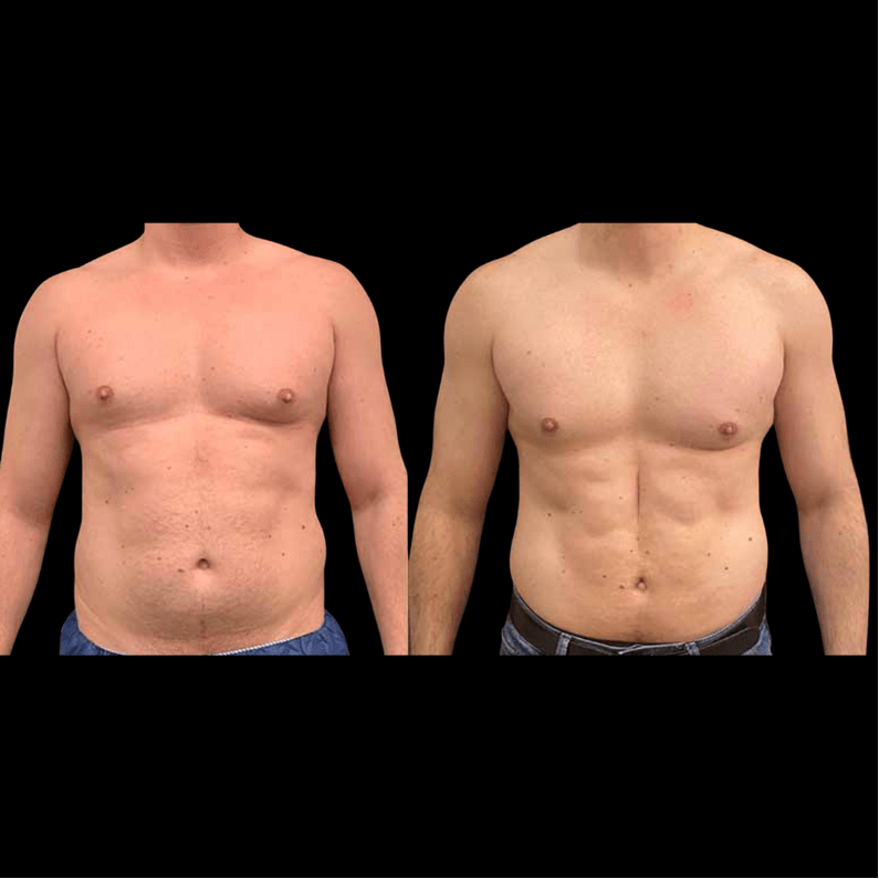 Before After Male Liposuction Results Neinstein Plastic Surgery