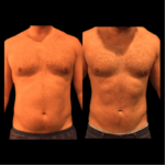 nps_before-after-male-abdomen-waist-lipo-360
