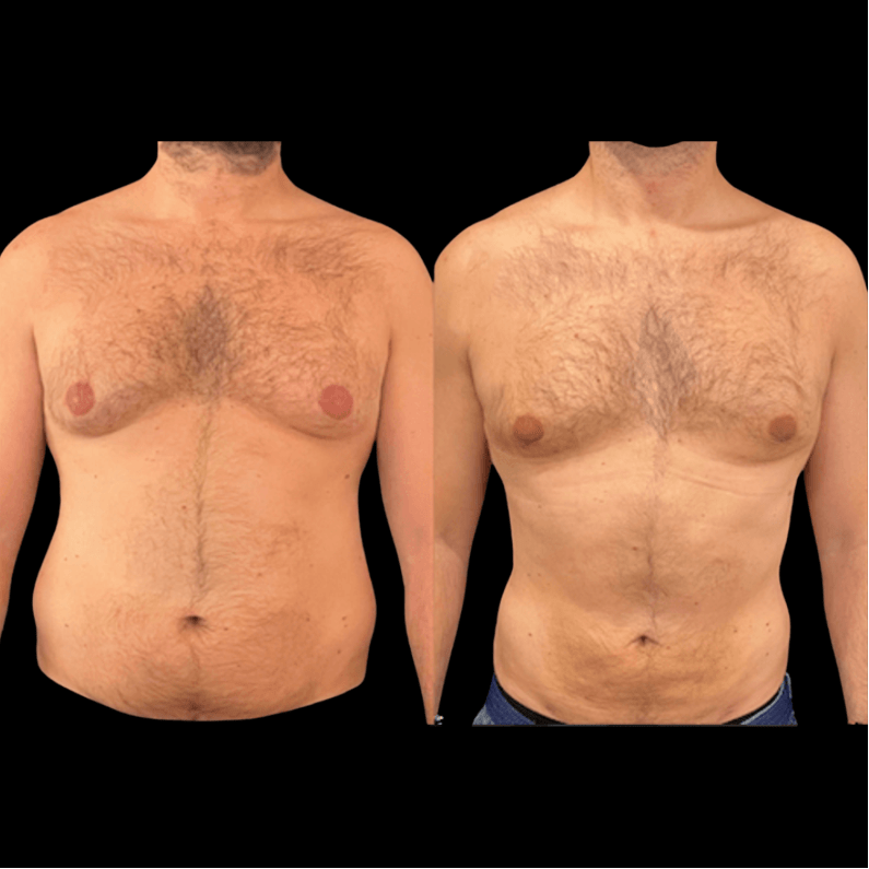 Best Liposuction Austin