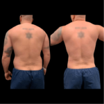 nps_before-after-male-back-lipo
