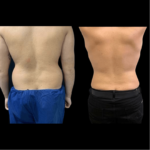 nps_before-after-male-back-lipo