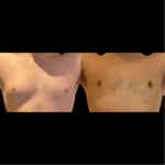 nps_before-after-male-gynecomastia