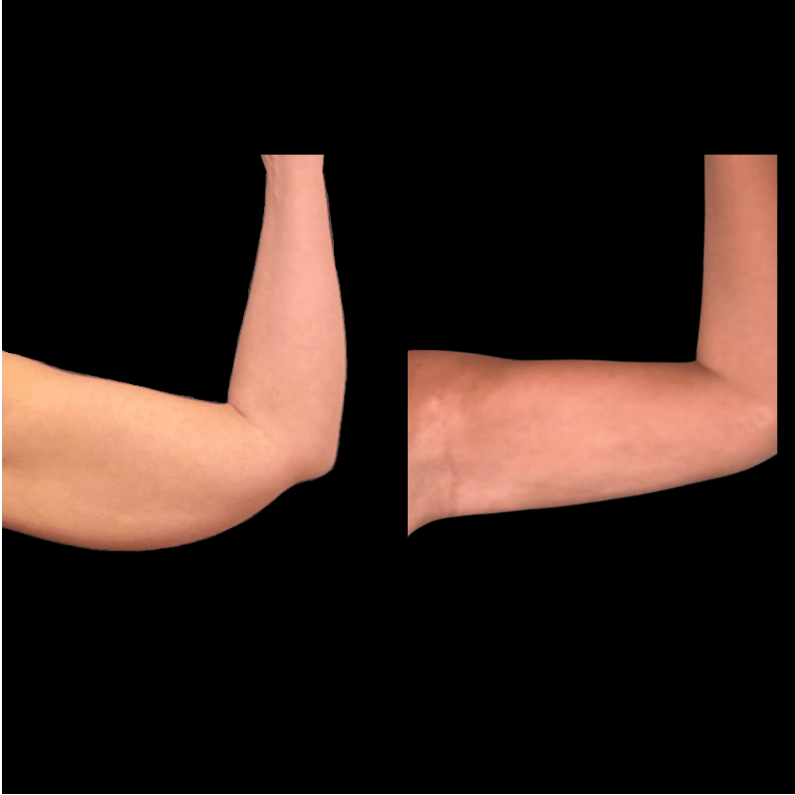 Before & After: Arms Liposuction - Neinstein Plastic Surgery