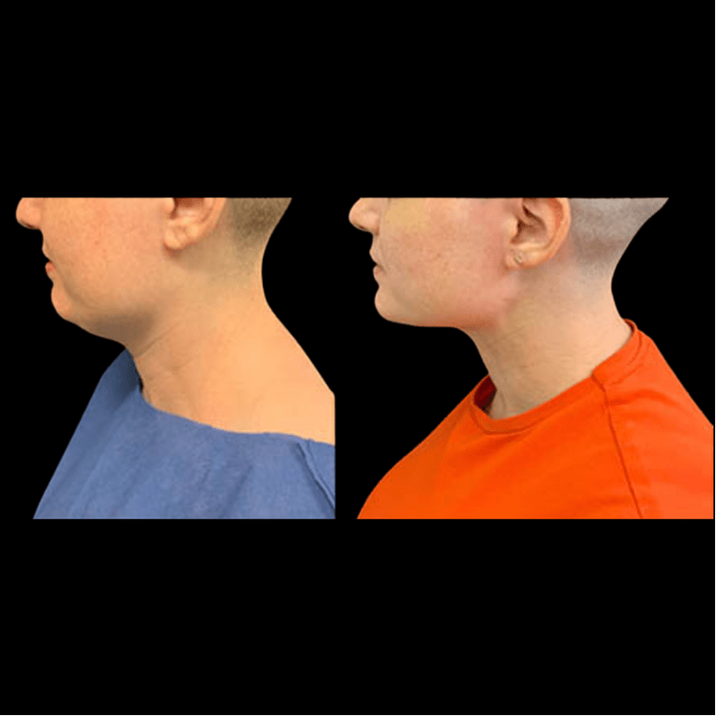 nps_before-after-neck