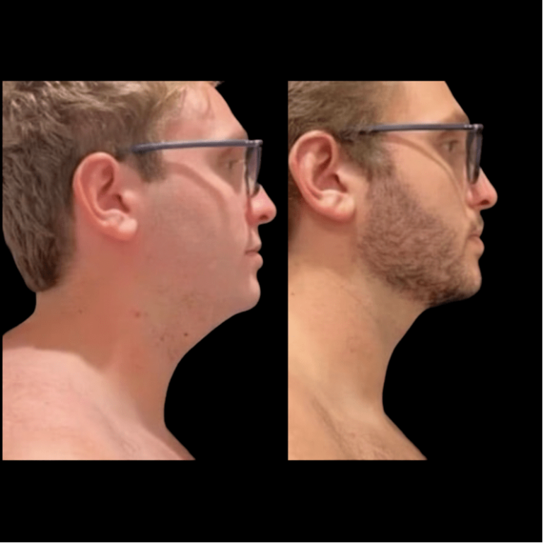 Before And After Neck Liposuction Neinstein Plastic Surgery