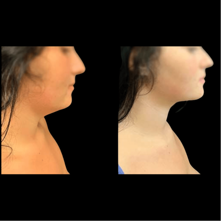 Before And After Neck Liposuction Neinstein Plastic Surgery