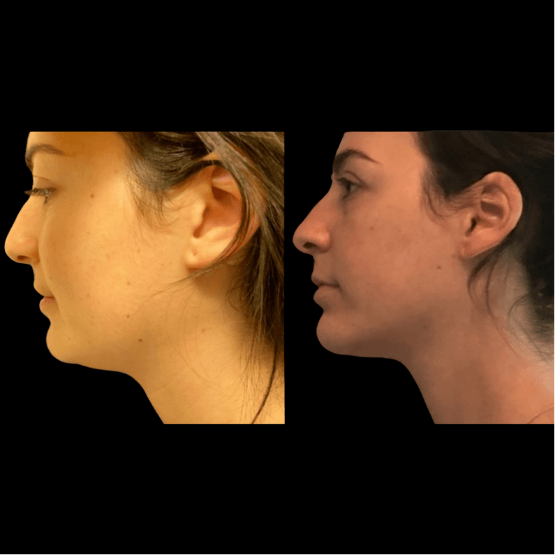 nps_before-after-neck