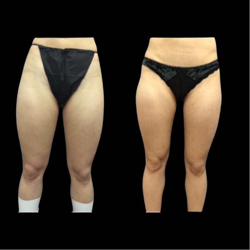 nps_before-after-thighs