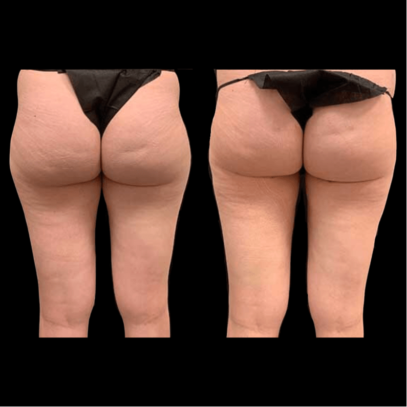 nps_before-after-thighs