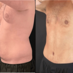 nps_funderburk-before-after-abdominoplasty-min