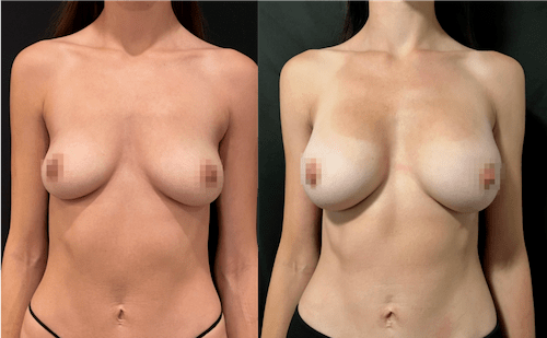 nps_funderburk-before-after-breast-augmentation