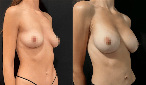 nps_funderburk-before-after-breast-augmentation