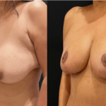 nps_funderburk-before-after-breast-augmentation