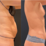 nps_funderburk-before-after-mini-tummy-tuck-min