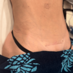 Diastasis Recti repair through mini tuck incision