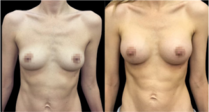 nps-breast-augmentation-1
