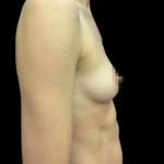 nps-breast-augmentation-240cc-1