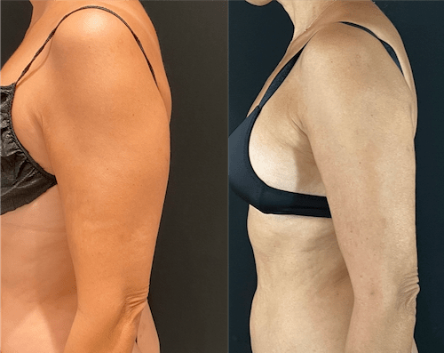 nps_before-after-arm-2-min