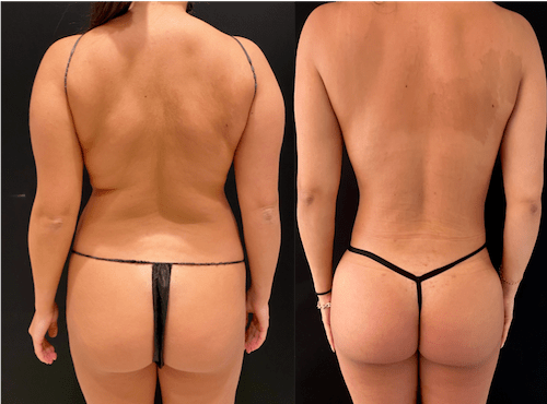 nps_before-after-lipo-360-min