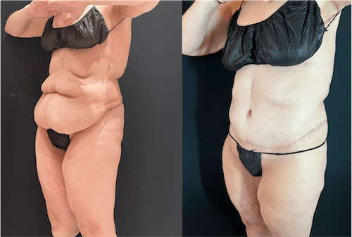 nps_before-after-tummy-tuck-8.17-min
