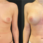 nps_breast-augmentation
