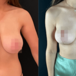 nps_breast-reduction