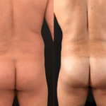 nps_dr-funderburk-before-after-male-bbl-23-min