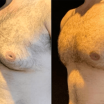 nps_dr-funderburk-gynecomastia-before-after-min